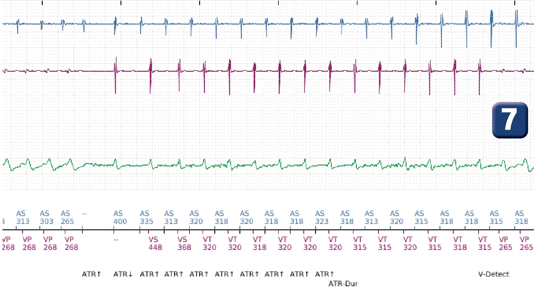 Électrogramme Boston Scientific DAI, segment 7 sur 10 — Discrimination double chambre et erreur de discrimination par altération du signal du canal de choc