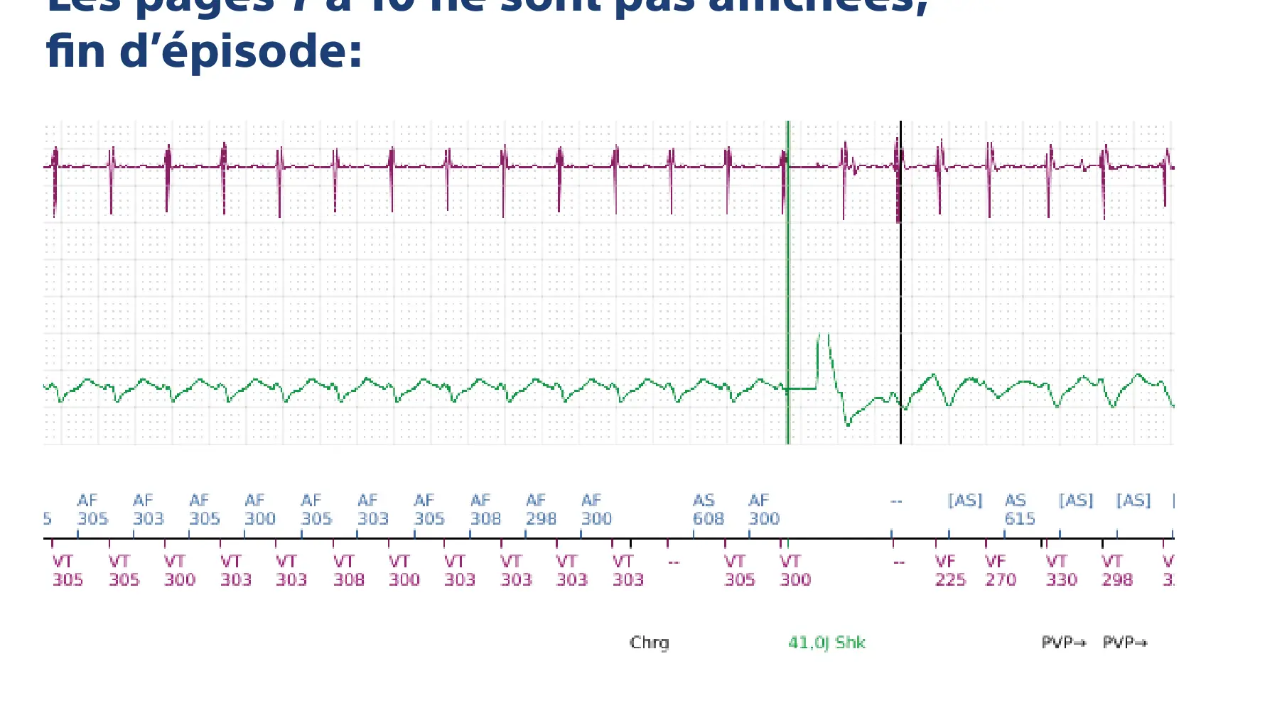 Électrogramme Boston Scientific DAI, segment 9 sur 10 — Discrimination double chambre et erreur de discrimination par altération du signal du canal de choc
