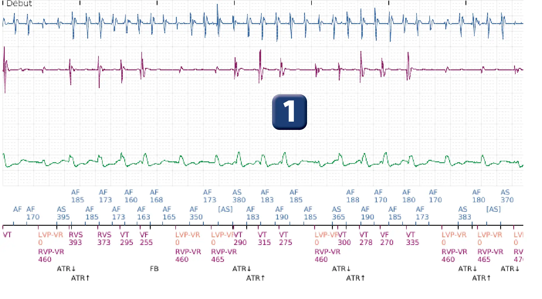 Électrogramme Boston Scientific DAI, segment 1 sur 12 — Discrimination double chambre, fibrillation auriculaire, début/stabilité