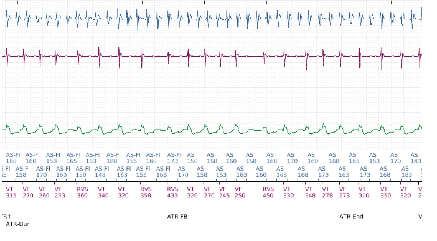 Électrogramme Boston Scientific DAI, segment 10 sur 12 — Discrimination double chambre, fibrillation auriculaire, début/stabilité