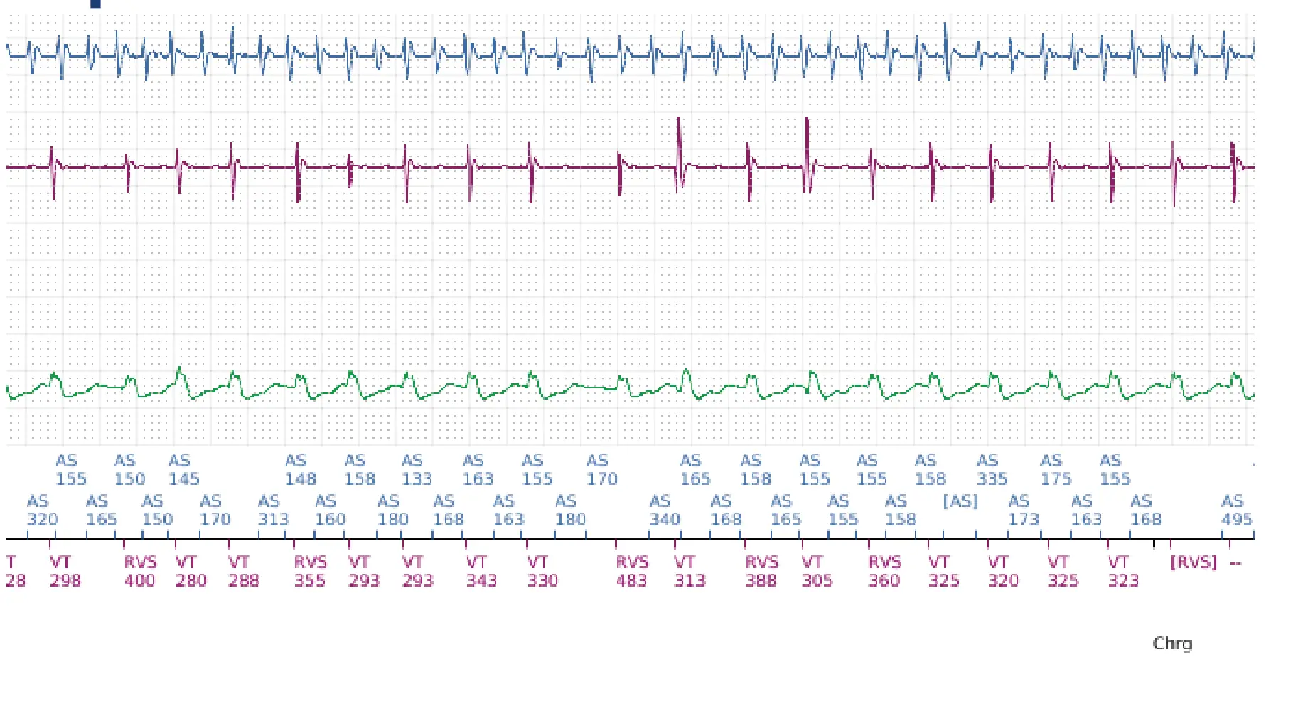 Électrogramme Boston Scientific DAI, segment 11 sur 12 — Discrimination double chambre, fibrillation auriculaire, début/stabilité