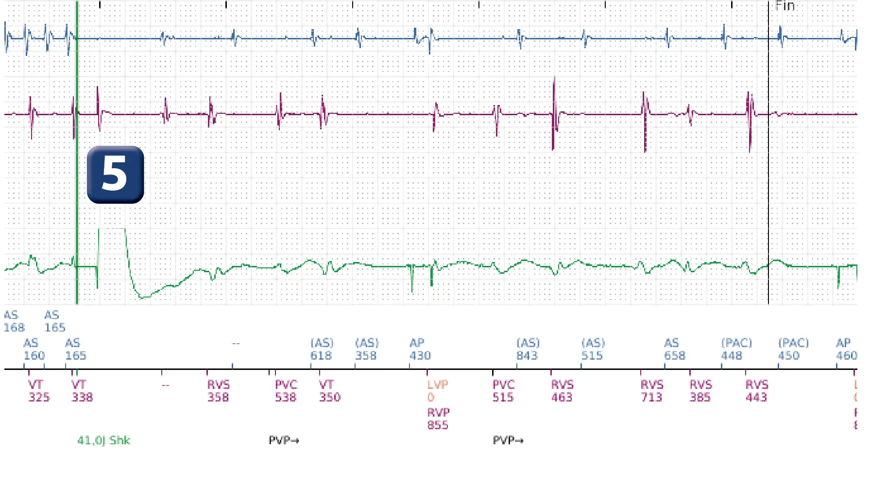 Électrogramme Boston Scientific DAI, segment 12 sur 12 — Discrimination double chambre, fibrillation auriculaire, début/stabilité