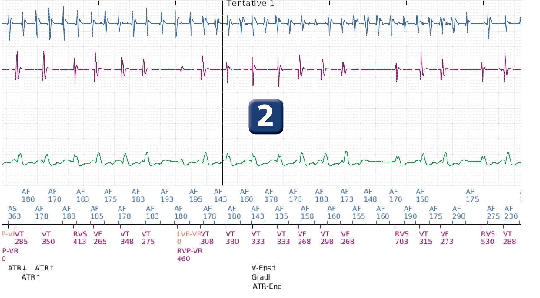 Électrogramme Boston Scientific DAI, segment 2 sur 12 — Discrimination double chambre, fibrillation auriculaire, début/stabilité