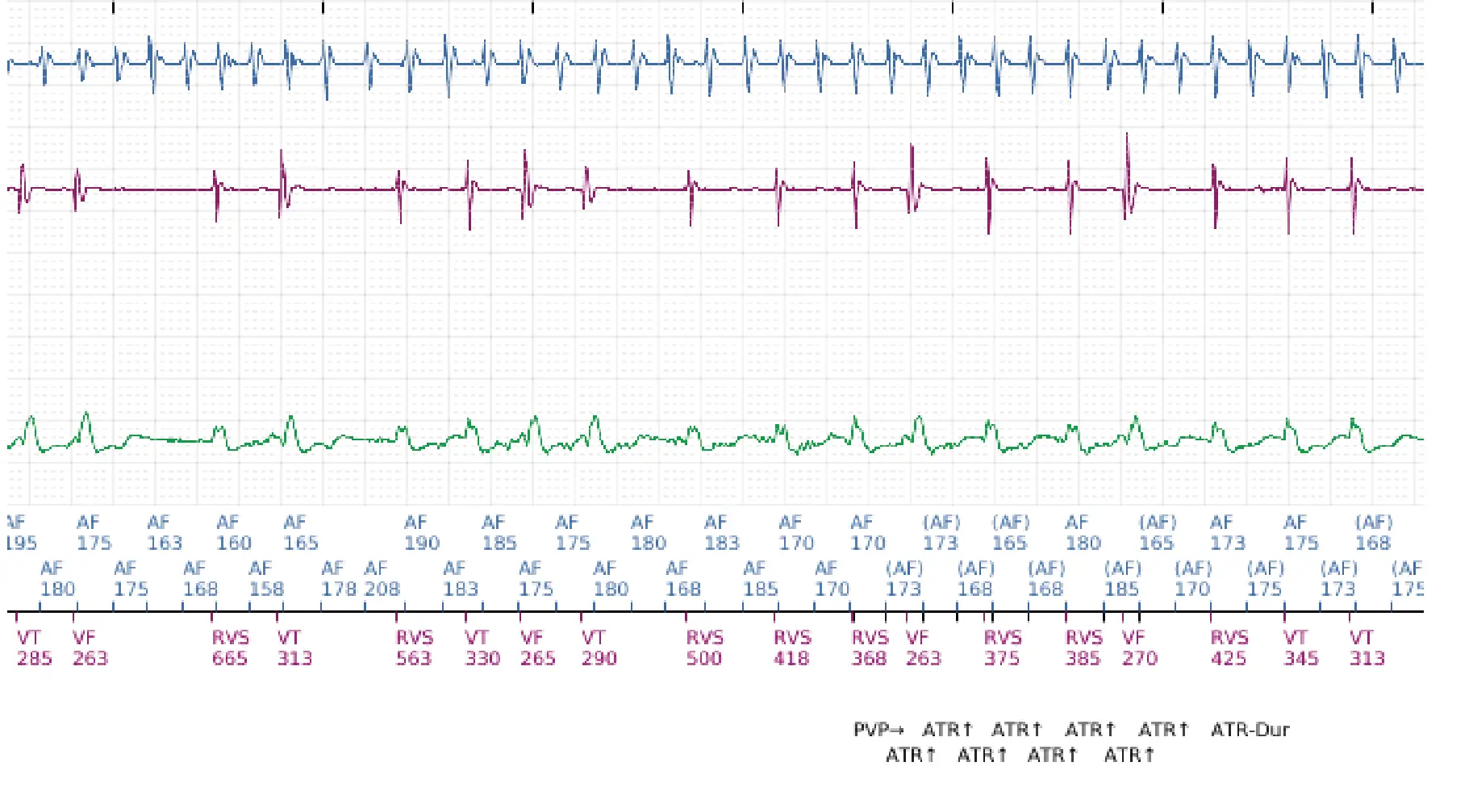 Électrogramme Boston Scientific DAI, segment 3 sur 12 — Discrimination double chambre, fibrillation auriculaire, début/stabilité