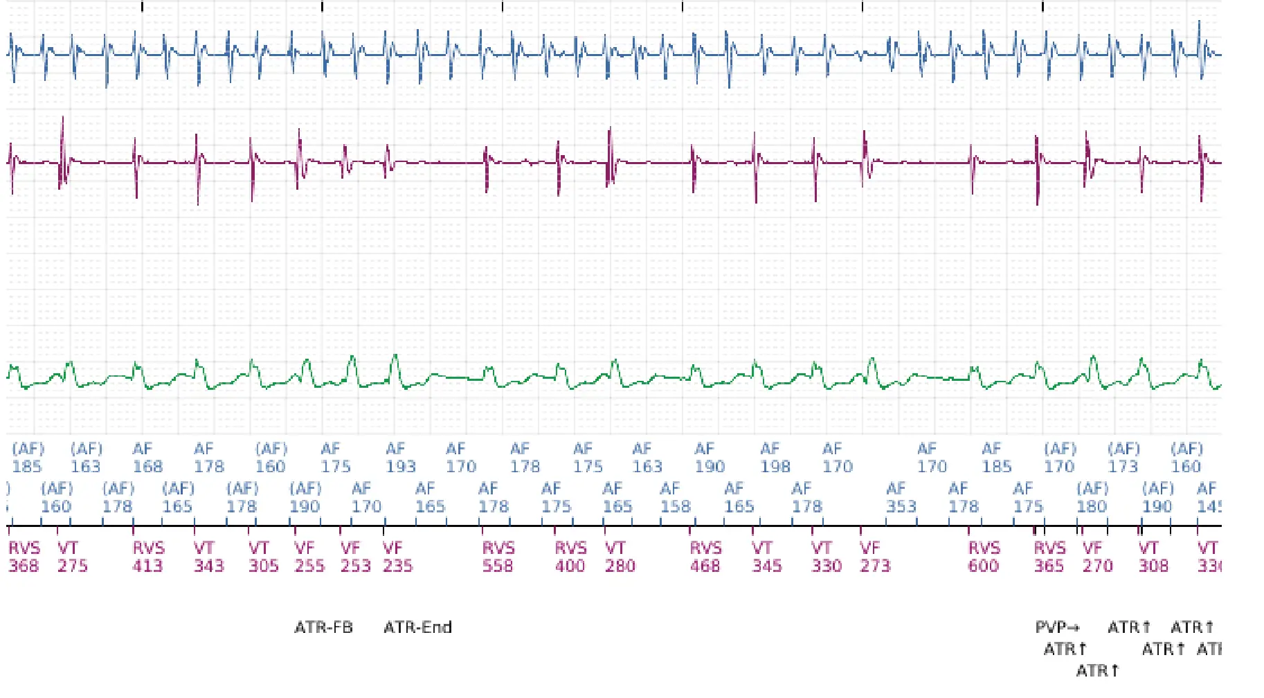 Électrogramme Boston Scientific DAI, segment 4 sur 12 — Discrimination double chambre, fibrillation auriculaire, début/stabilité