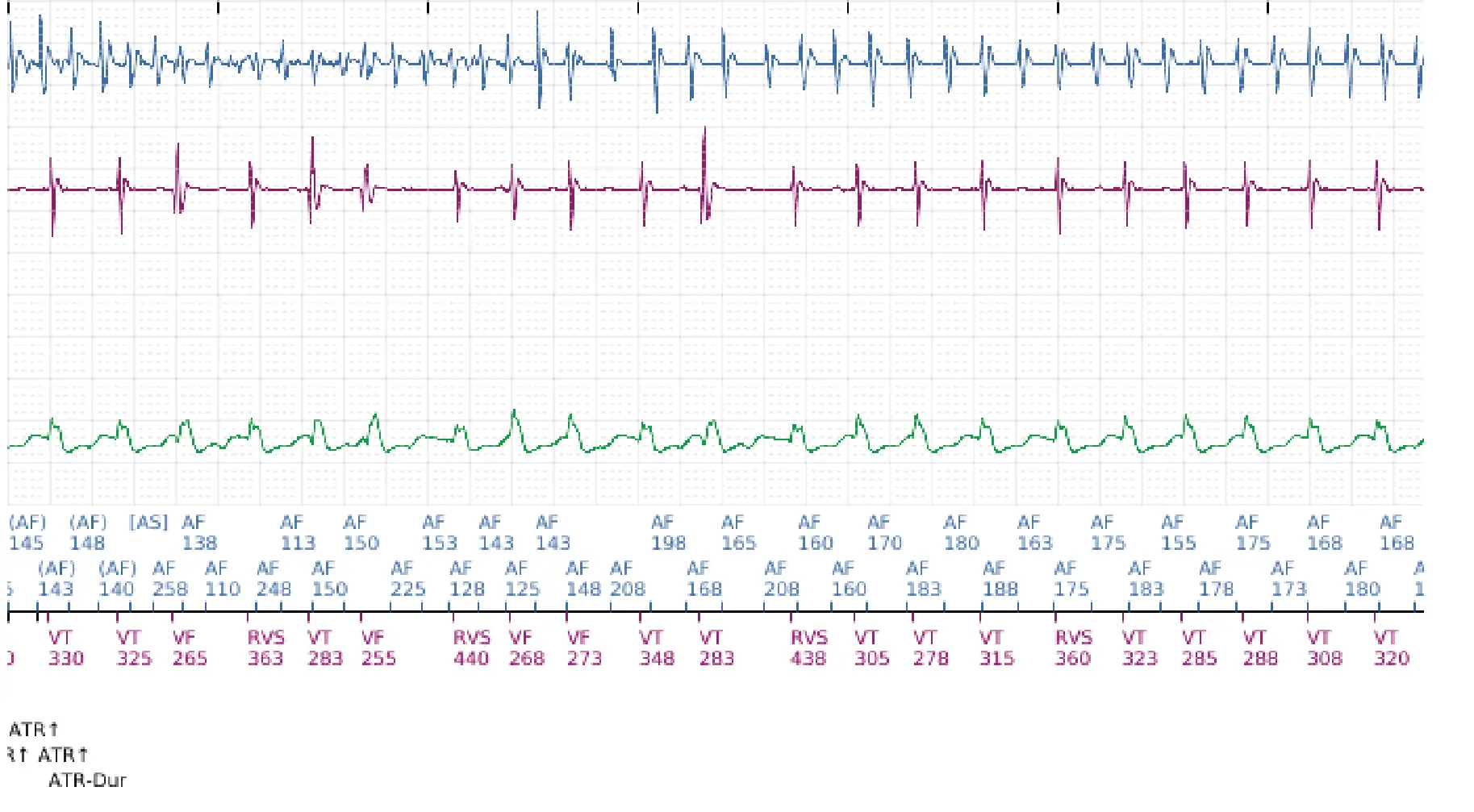 Électrogramme Boston Scientific DAI, segment 5 sur 12 — Discrimination double chambre, fibrillation auriculaire, début/stabilité