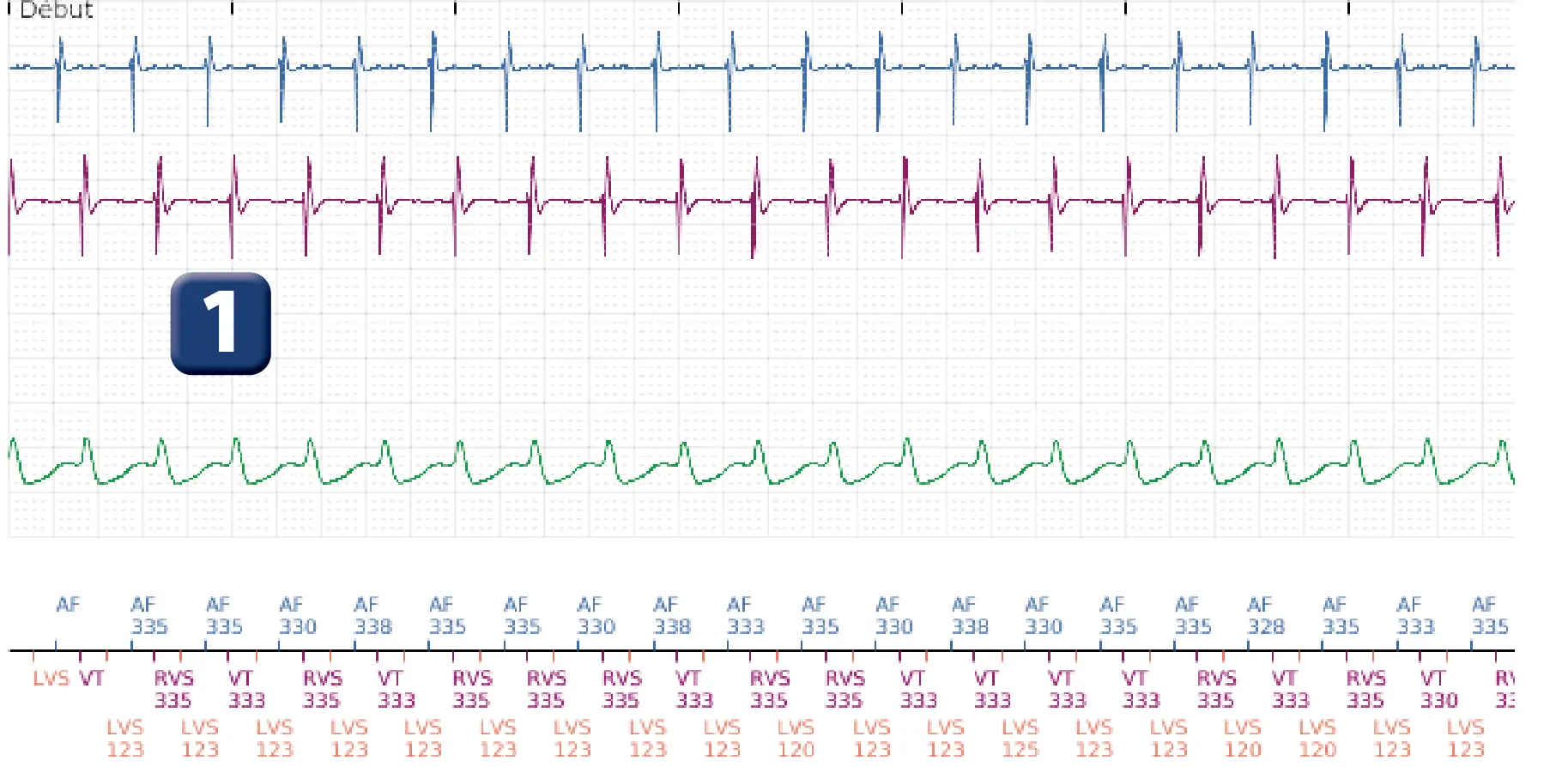 Électrogramme Boston Scientific DAI, segment 1 sur 3 — Discrimination double chambre, tachycardie atriale, début/stabilité