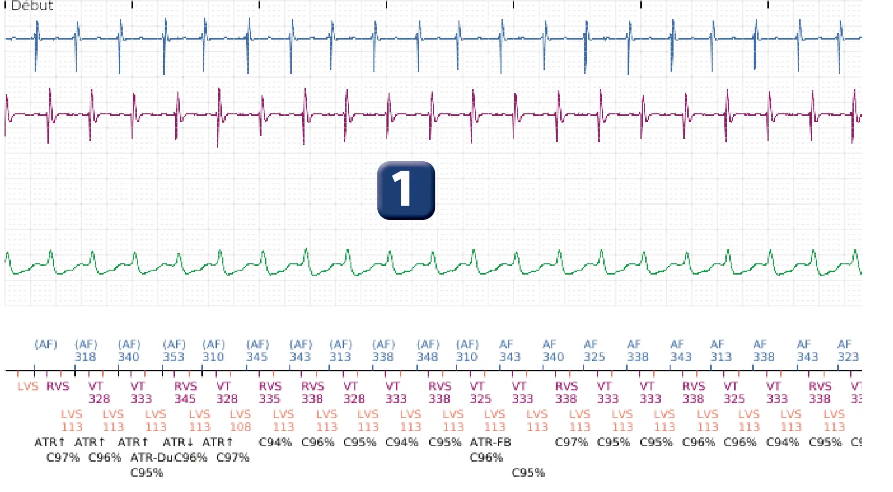 Électrogramme Boston Scientific DAI, segment 1 sur 4 — Discrimination double chambre, tachycardie atriale, début/stabilité