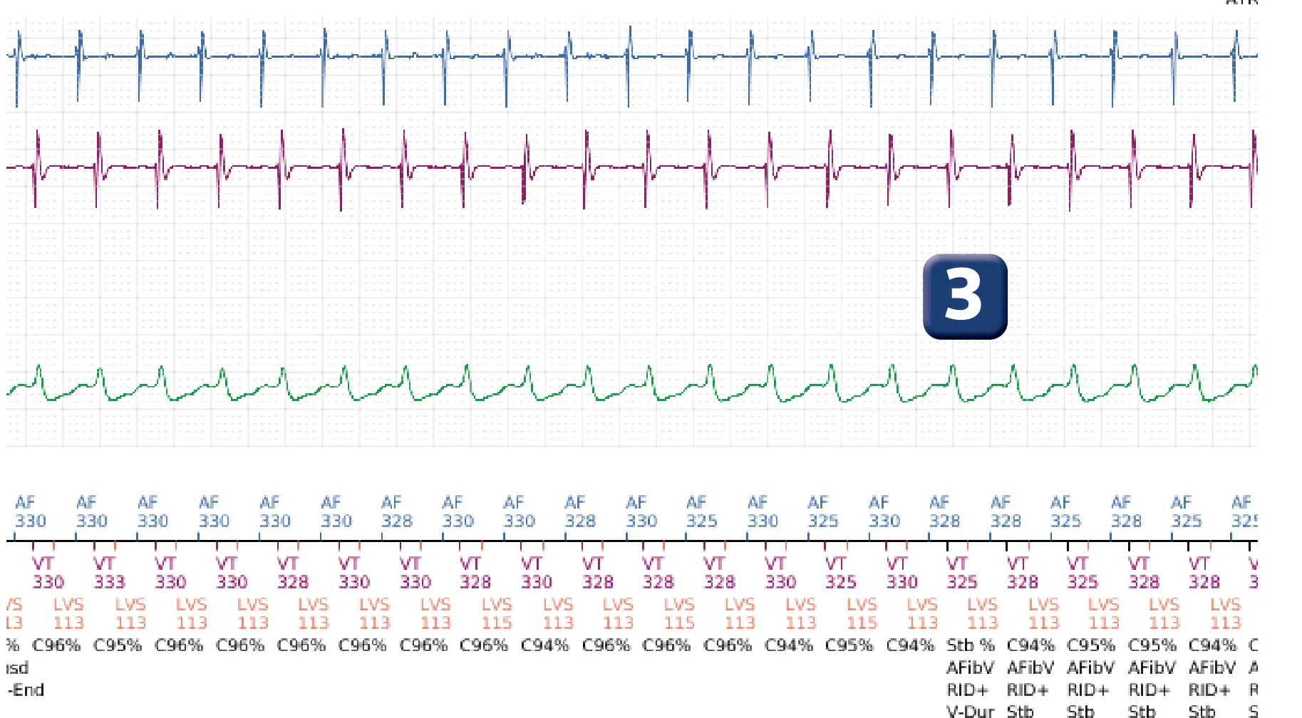 Électrogramme Boston Scientific DAI, segment 3 sur 4 — Discrimination double chambre, tachycardie atriale, début/stabilité