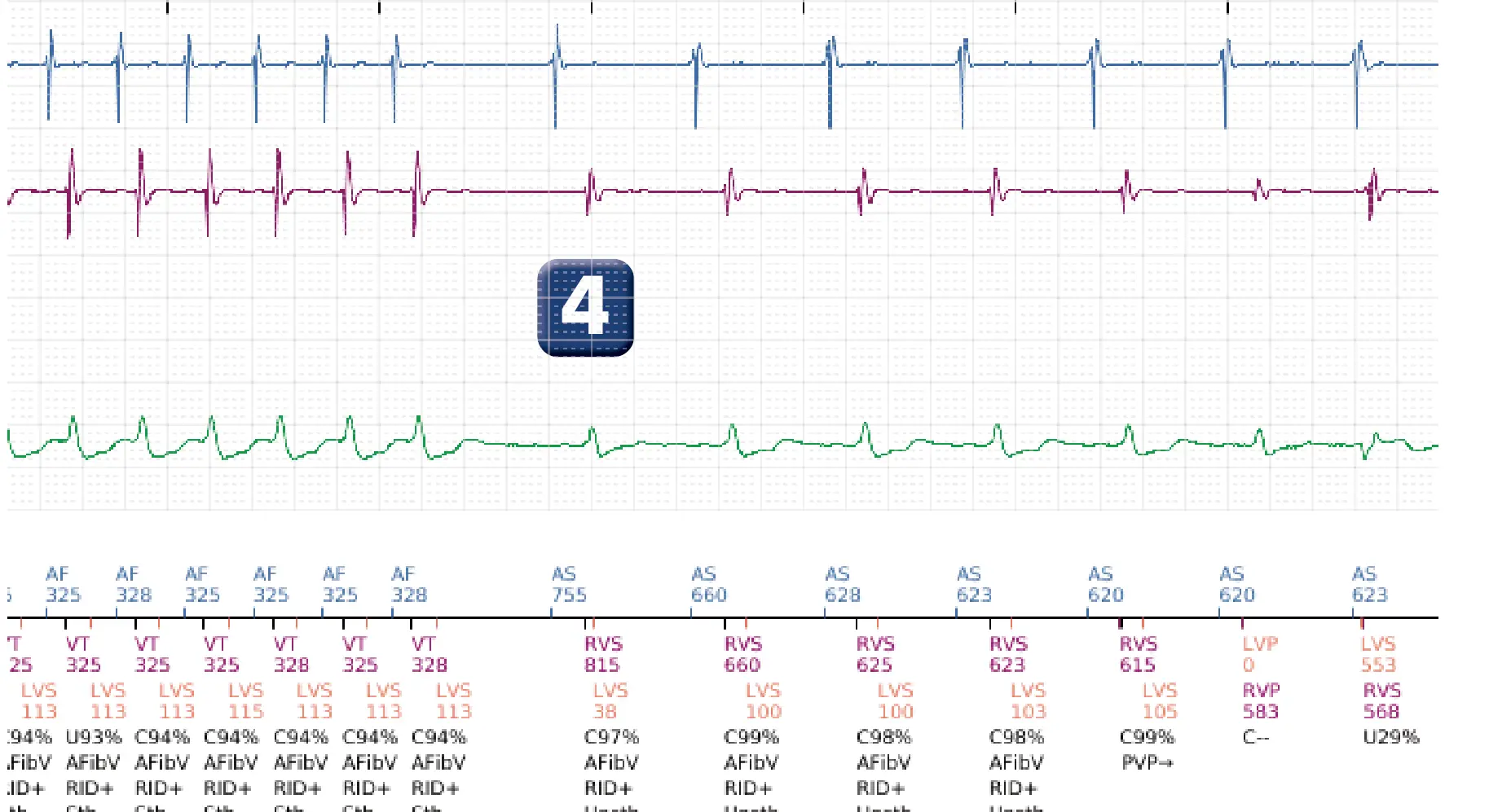 Électrogramme Boston Scientific DAI, segment 4 sur 4 — Discrimination double chambre, tachycardie atriale, début/stabilité
