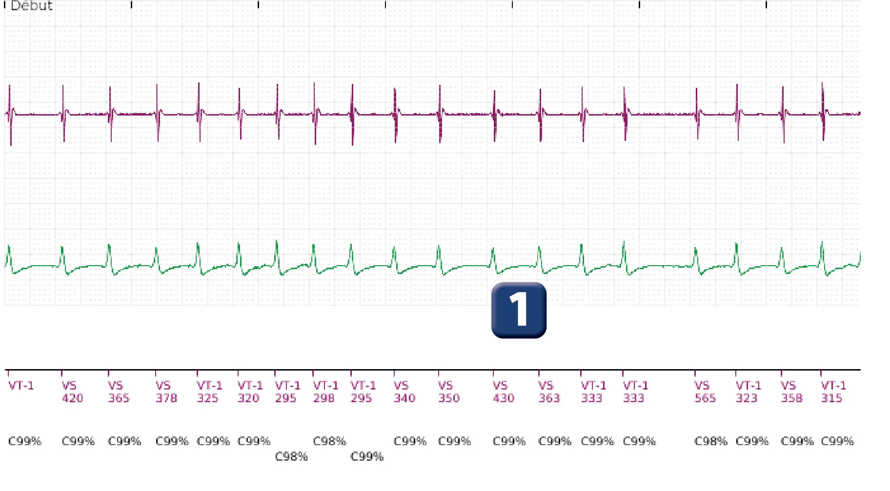Électrogramme Boston Scientific DAI, segment 1 sur 5 — Discrimination simple chambre, ID de rythme et épisode de fibrillation auriculaire