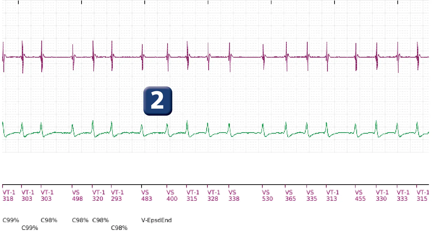 Électrogramme Boston Scientific DAI, segment 2 sur 5 — Discrimination simple chambre, ID de rythme et épisode de fibrillation auriculaire