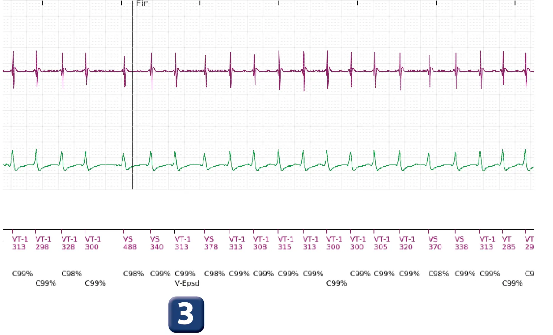 Électrogramme Boston Scientific DAI, segment 3 sur 5 — Discrimination simple chambre, ID de rythme et épisode de fibrillation auriculaire