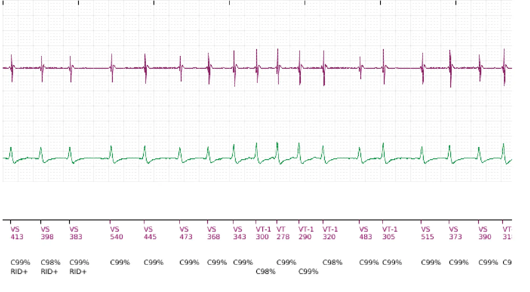 Électrogramme Boston Scientific DAI, segment 5 sur 5 — Discrimination simple chambre, ID de rythme et épisode de fibrillation auriculaire