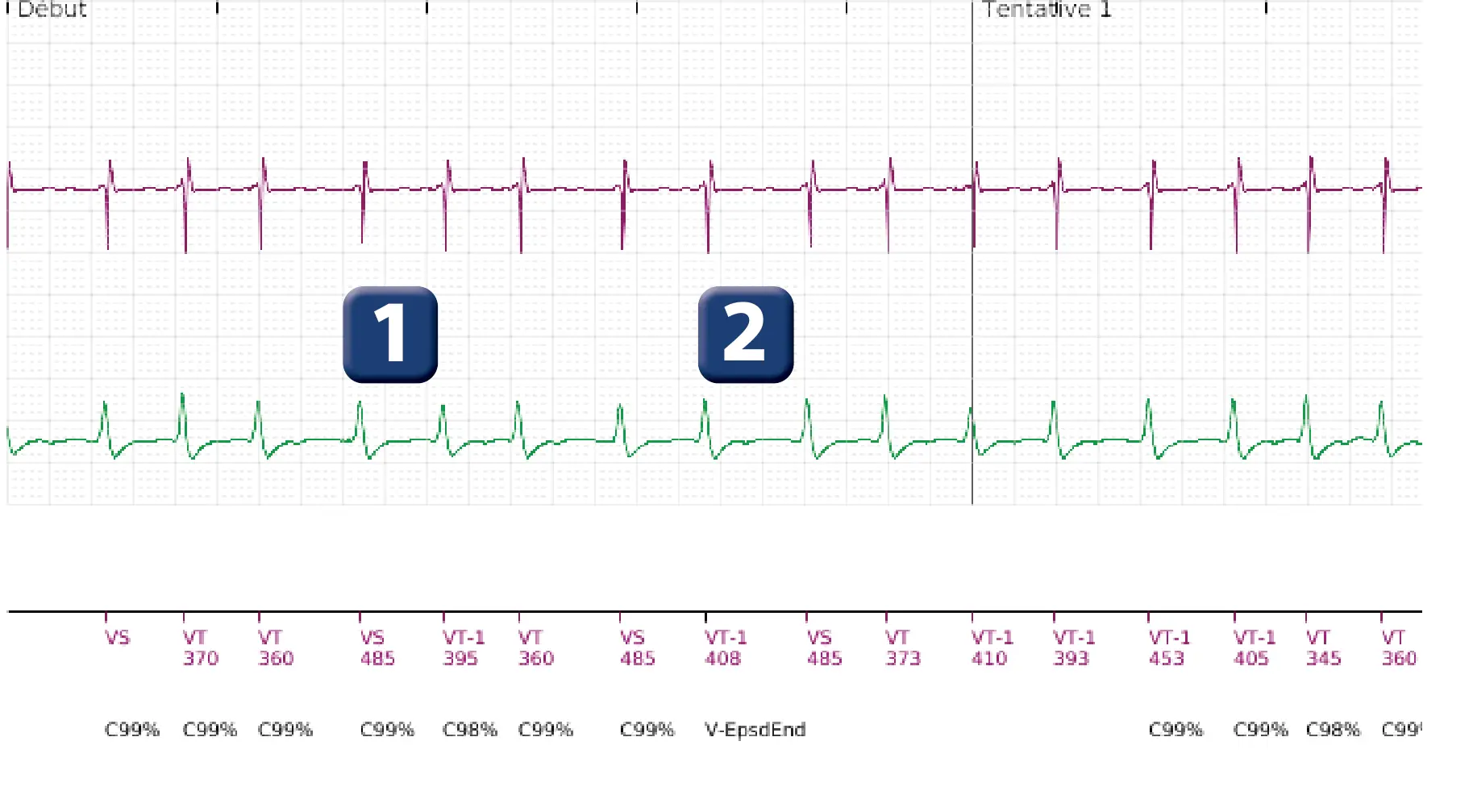 Électrogramme Boston Scientific DAI, segment 1 sur 18 — Discrimination simple chambre, ID de rythme et DFS