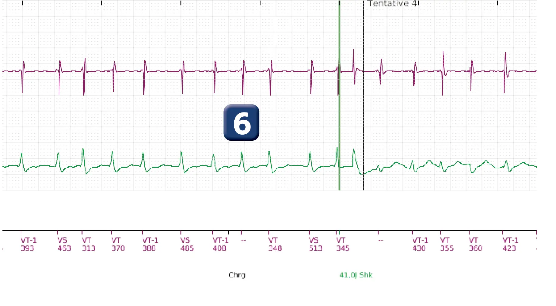 Électrogramme Boston Scientific DAI, segment 14 sur 18 — Discrimination simple chambre, ID de rythme et DFS