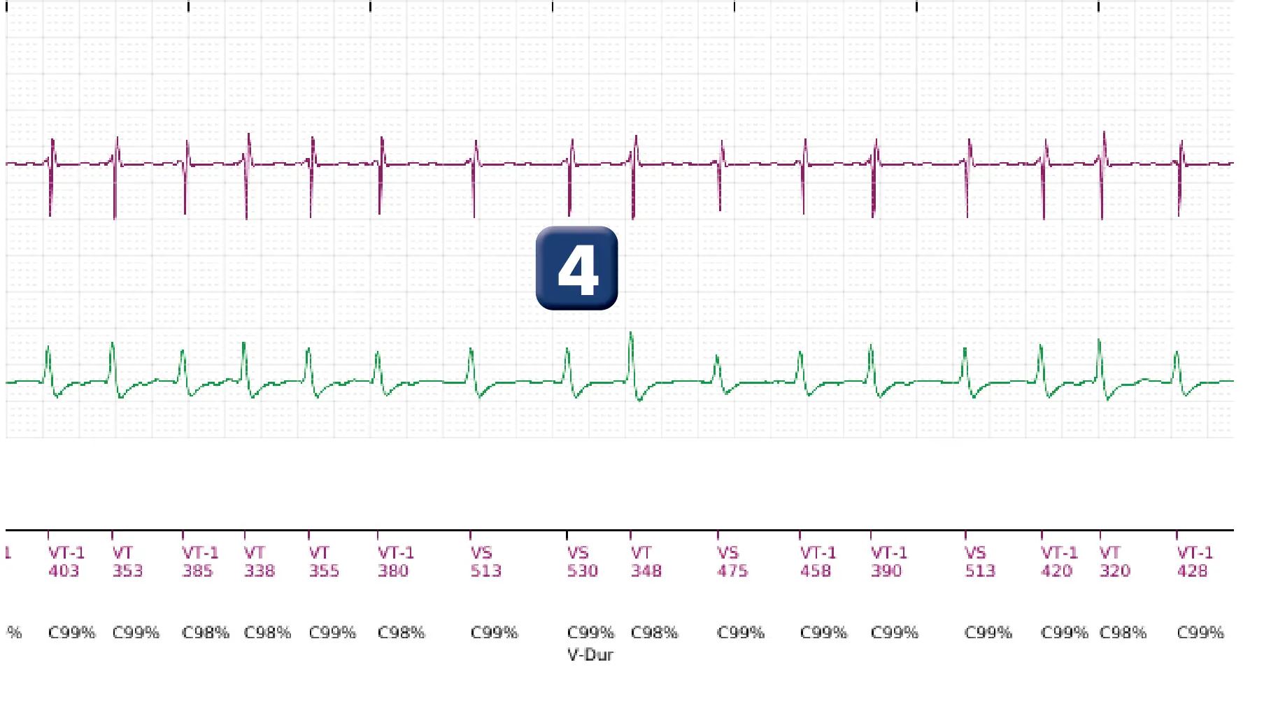 Électrogramme Boston Scientific DAI, segment 5 sur 18 — Discrimination simple chambre, ID de rythme et DFS