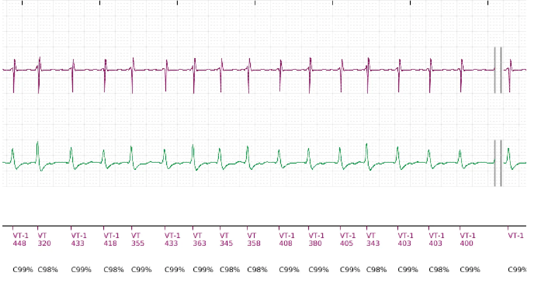 Électrogramme Boston Scientific DAI, segment 6 sur 18 — Discrimination simple chambre, ID de rythme et DFS