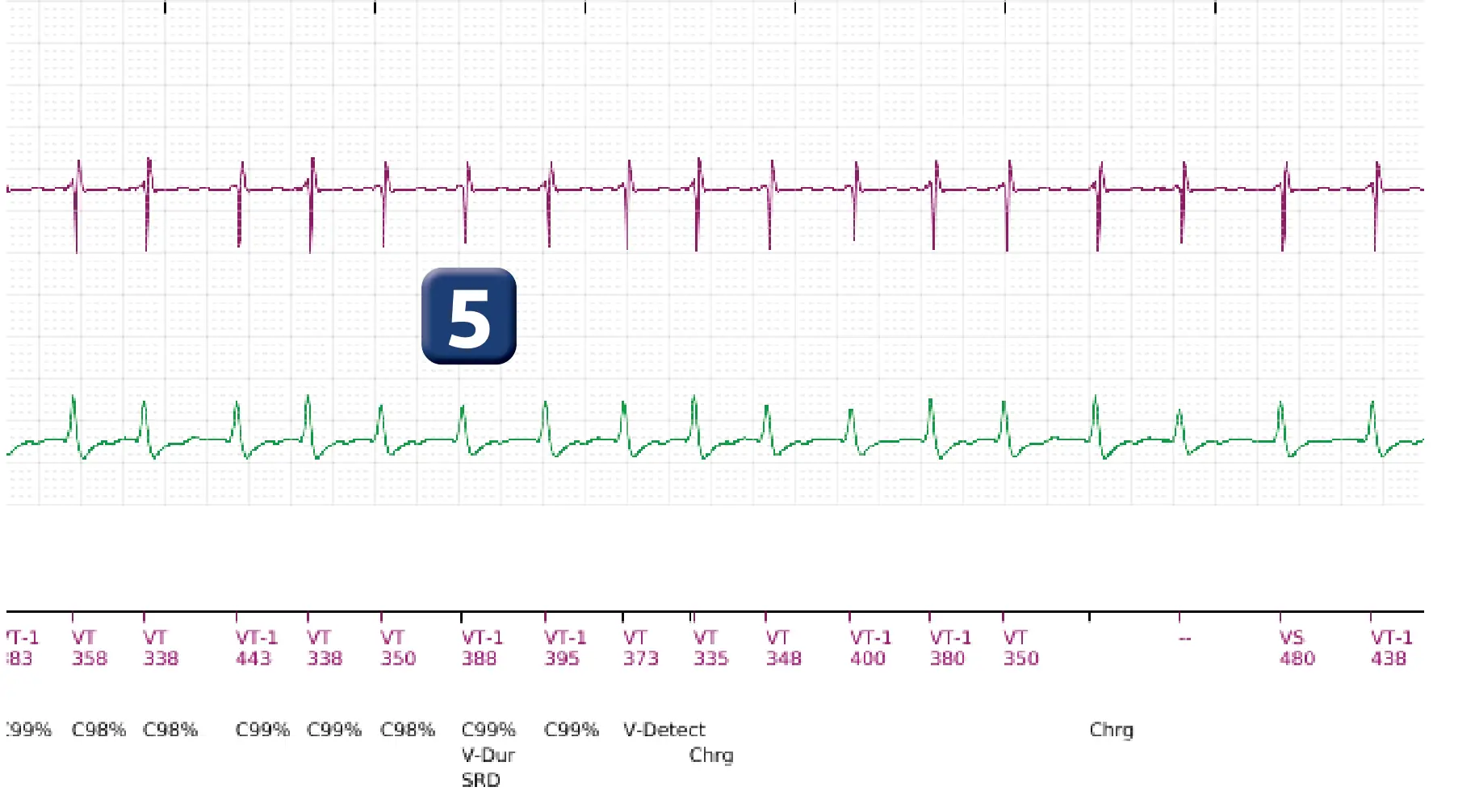 Électrogramme Boston Scientific DAI, segment 8 sur 18 — Discrimination simple chambre, ID de rythme et DFS