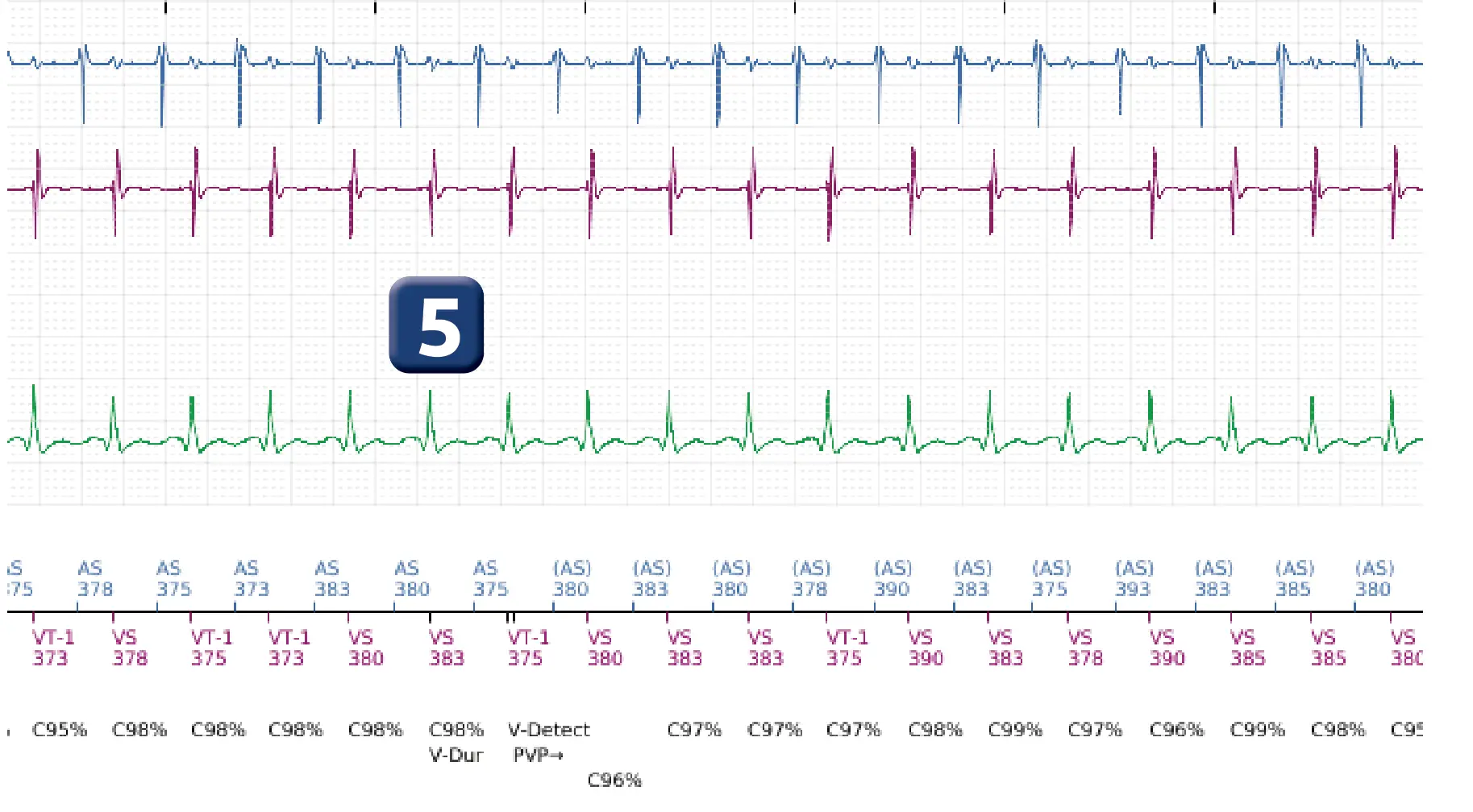 Électrogramme Boston Scientific DAI, segment 4 sur 5 — Discrimination double chambre et tachycardie sinusale