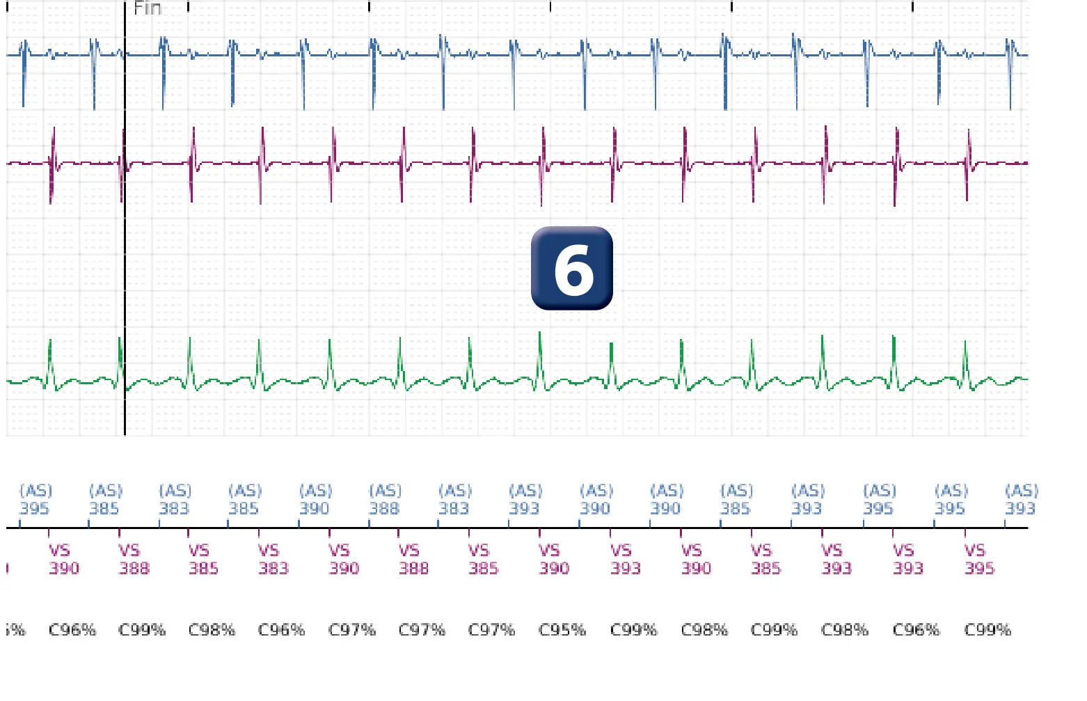 Électrogramme Boston Scientific DAI, segment 5 sur 5 — Discrimination double chambre et tachycardie sinusale
