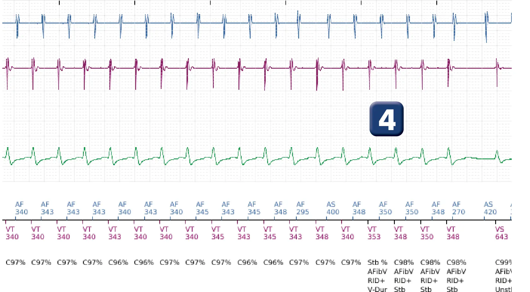 Électrogramme Boston Scientific DAI, segment 4 sur 5 — Discrimination double chambre et tachycardie atriale