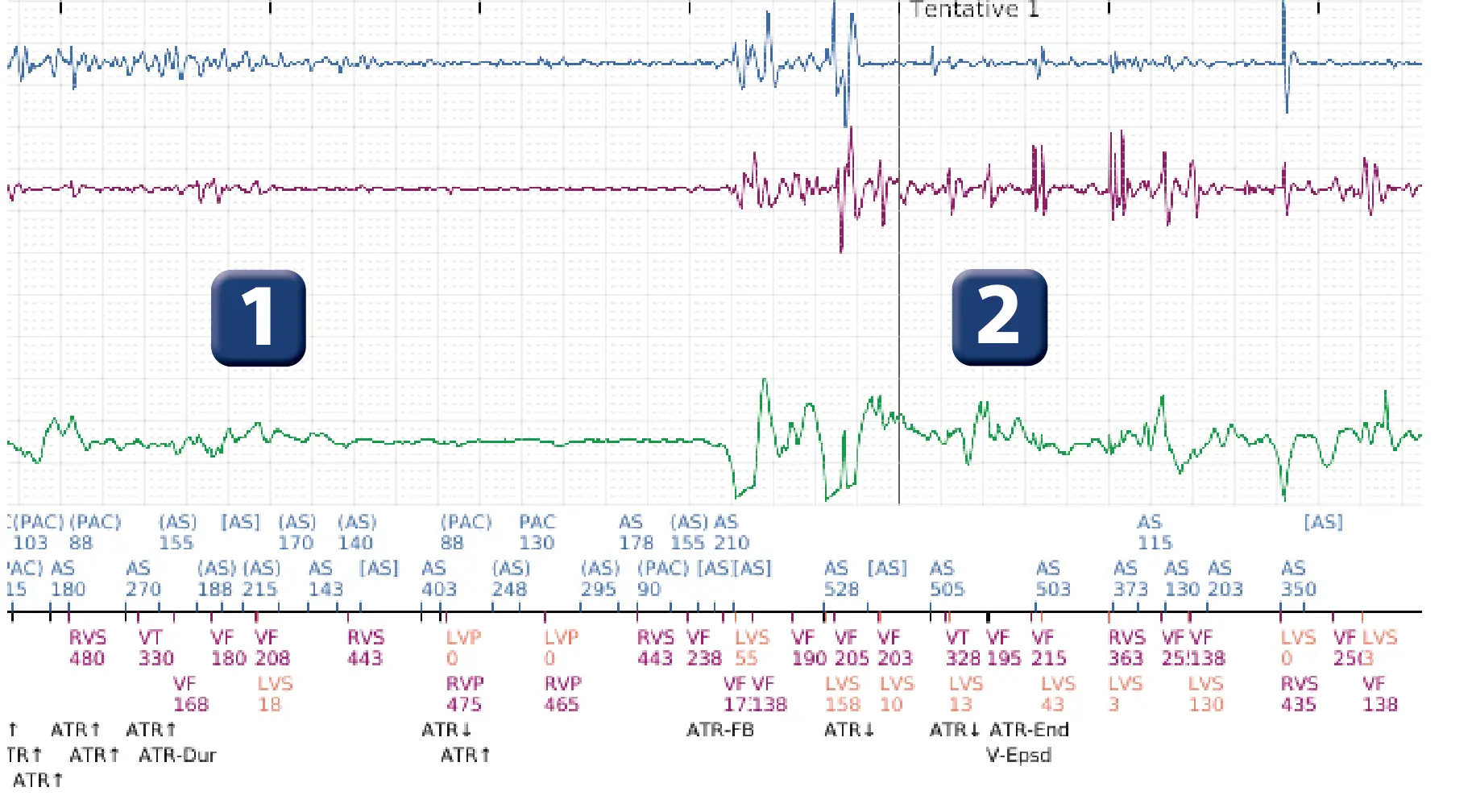 Électrogramme Boston Scientific DAI, segment 1 sur 2 — Intervention chirurgicale et FV au moment de la reperfusion