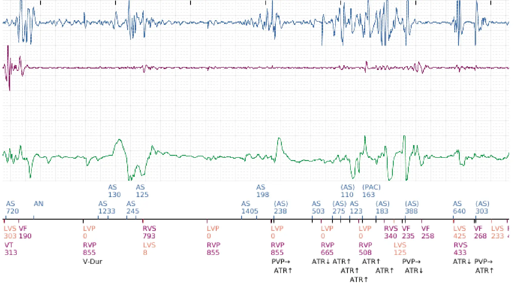Électrogramme Boston Scientific DAI, segment 2 sur 2 — Intervention chirurgicale et FV au moment de la reperfusion