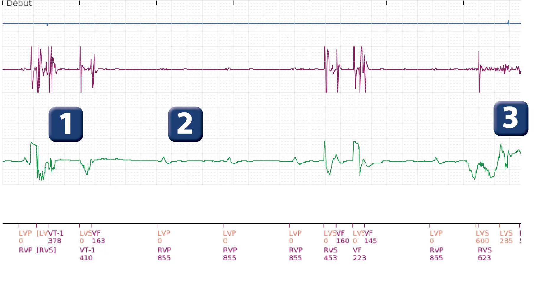 Électrogramme Boston Scientific DAI, segment 1 sur 5 — Intervention chirurgicale et FV au moment de la reperfusion