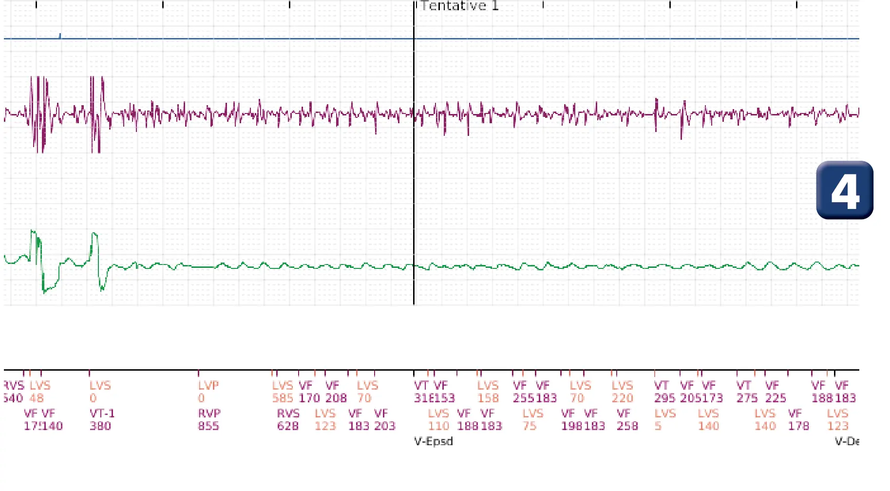 Électrogramme Boston Scientific DAI, segment 2 sur 5 — Intervention chirurgicale et FV au moment de la reperfusion