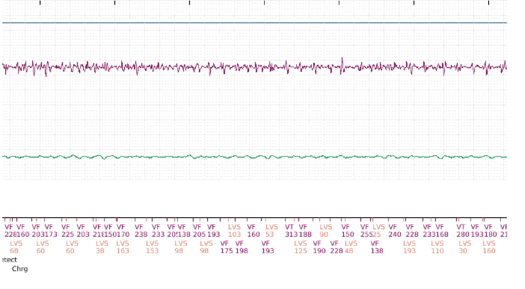 Électrogramme Boston Scientific DAI, segment 3 sur 5 — Intervention chirurgicale et FV au moment de la reperfusion