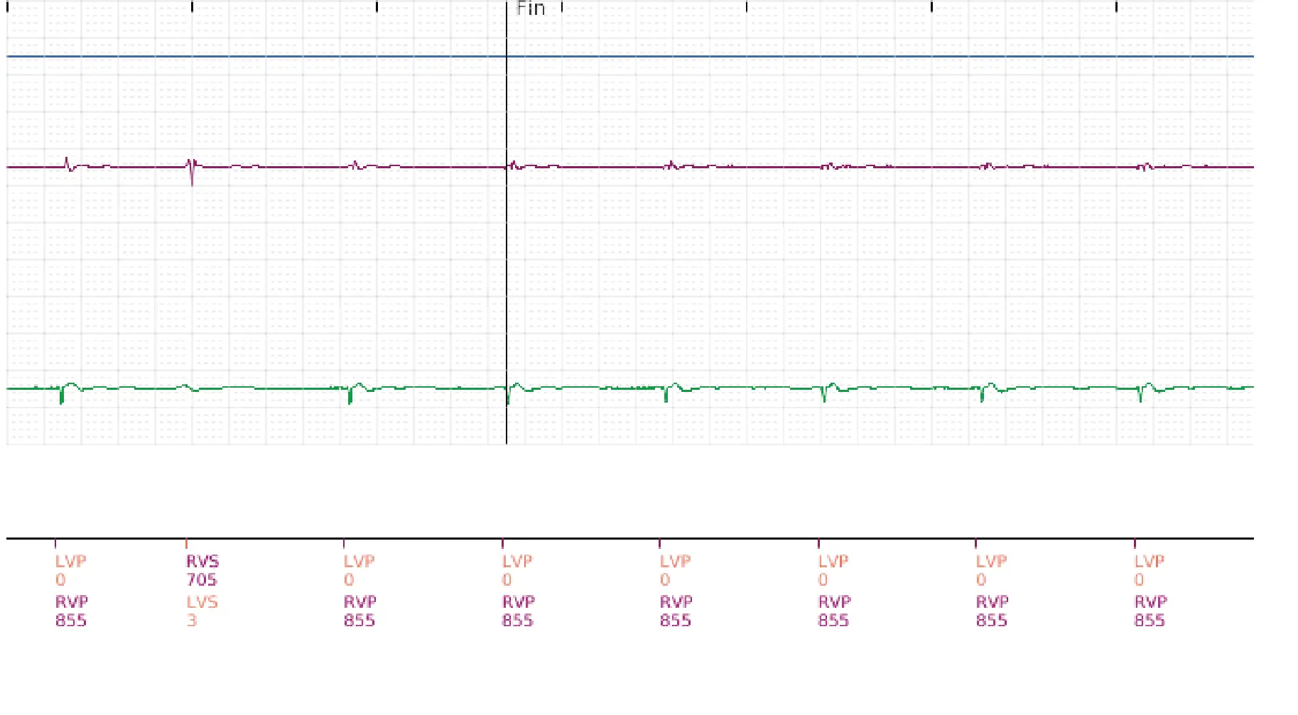 Électrogramme Boston Scientific DAI, segment 5 sur 5 — Intervention chirurgicale et FV au moment de la reperfusion