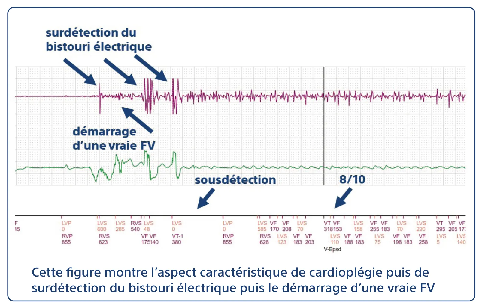 Cette figure montre l’aspect caractéristique de cardioplégie puis de surdétection du bistouri électrique puis le démarrage d’une vraie FV