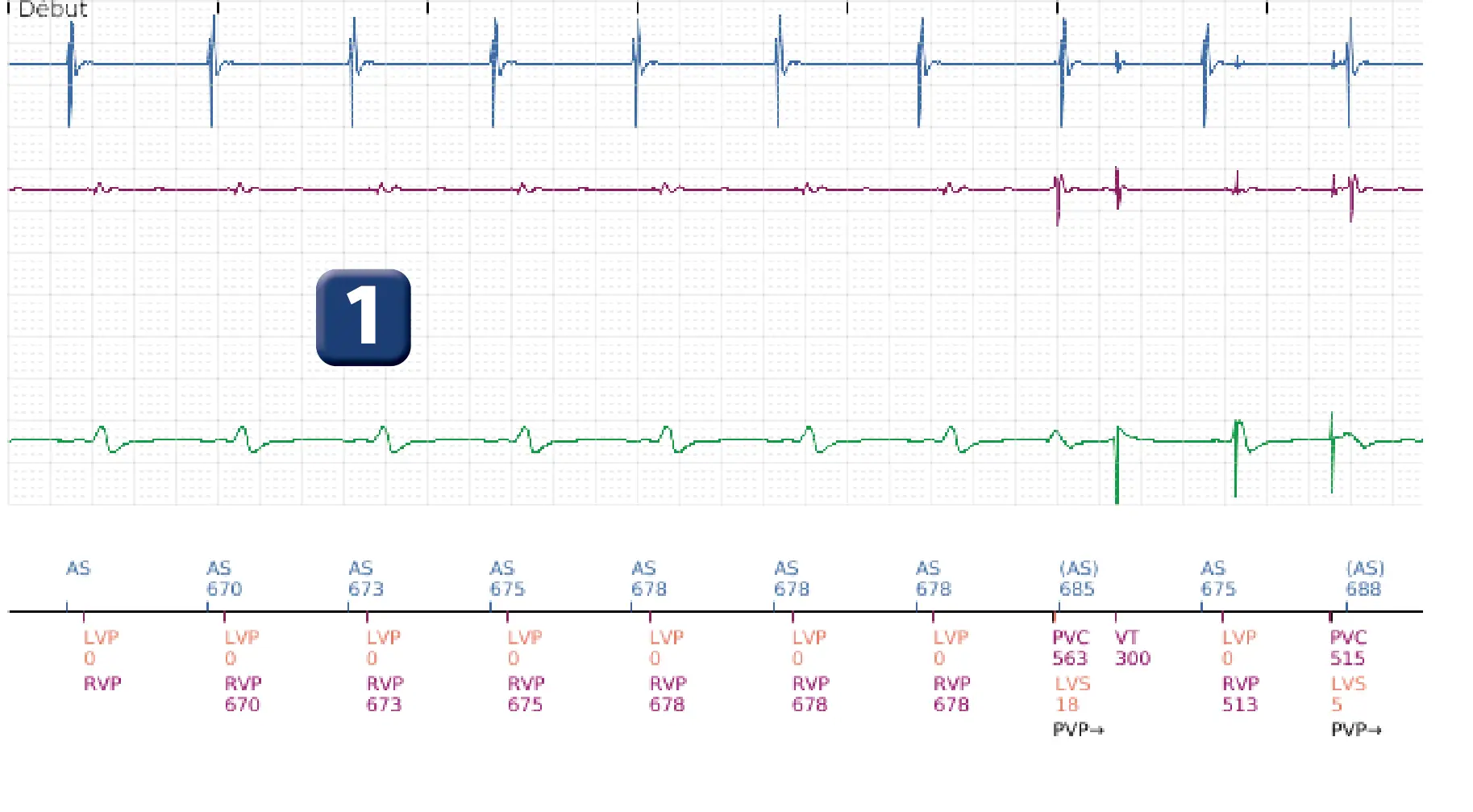 Électrogramme Boston Scientific DAI, segment 1 sur 6 — Thérapies inappropriées lors d’une procédure de TAVI