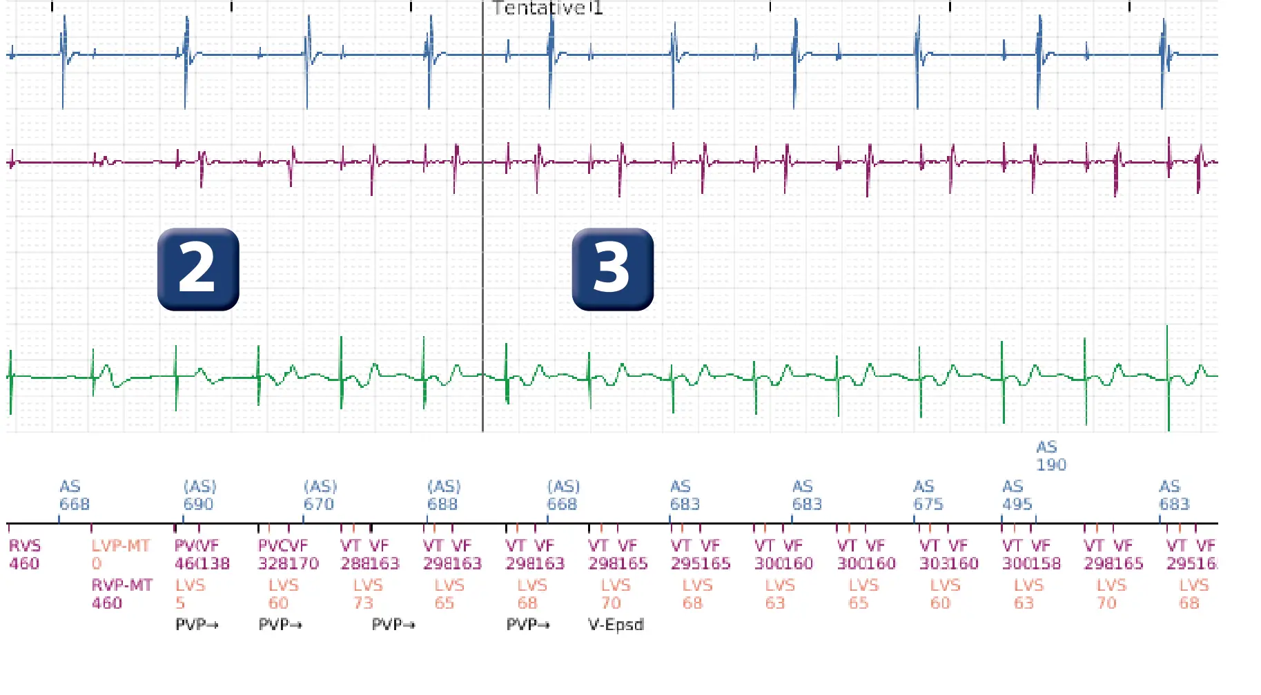 Électrogramme Boston Scientific DAI, segment 2 sur 6 — Thérapies inappropriées lors d’une procédure de TAVI