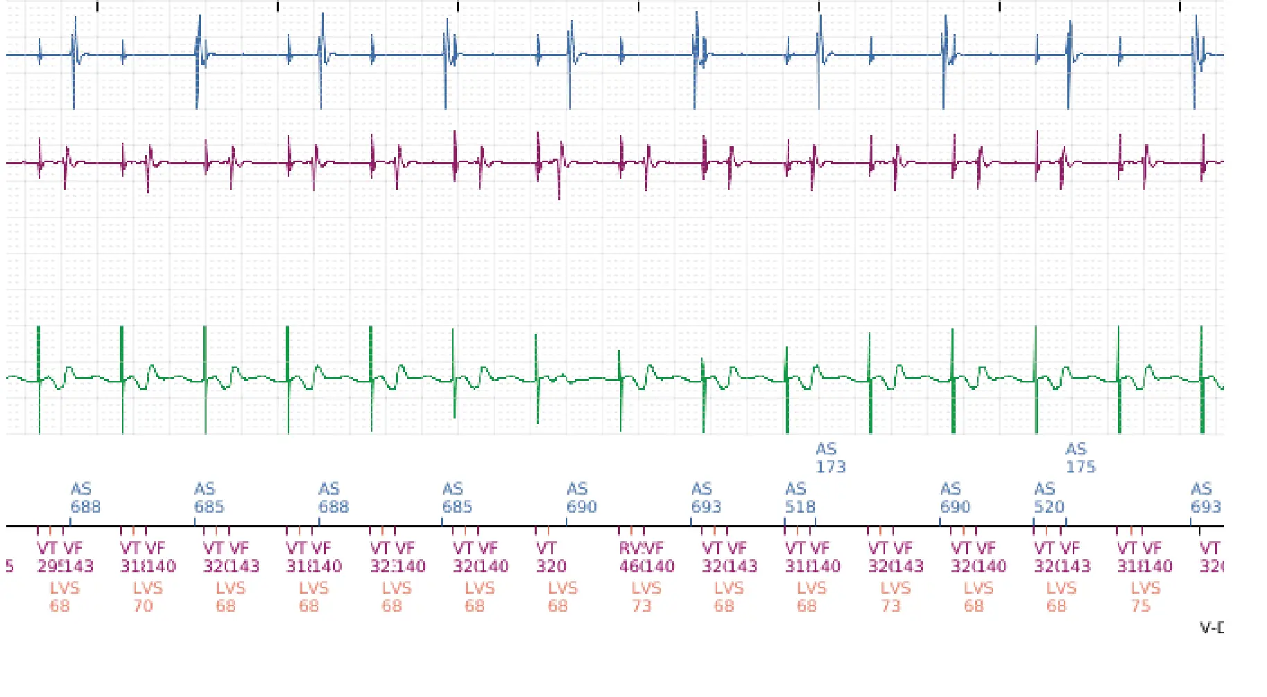 Électrogramme Boston Scientific DAI, segment 3 sur 6 — Thérapies inappropriées lors d’une procédure de TAVI