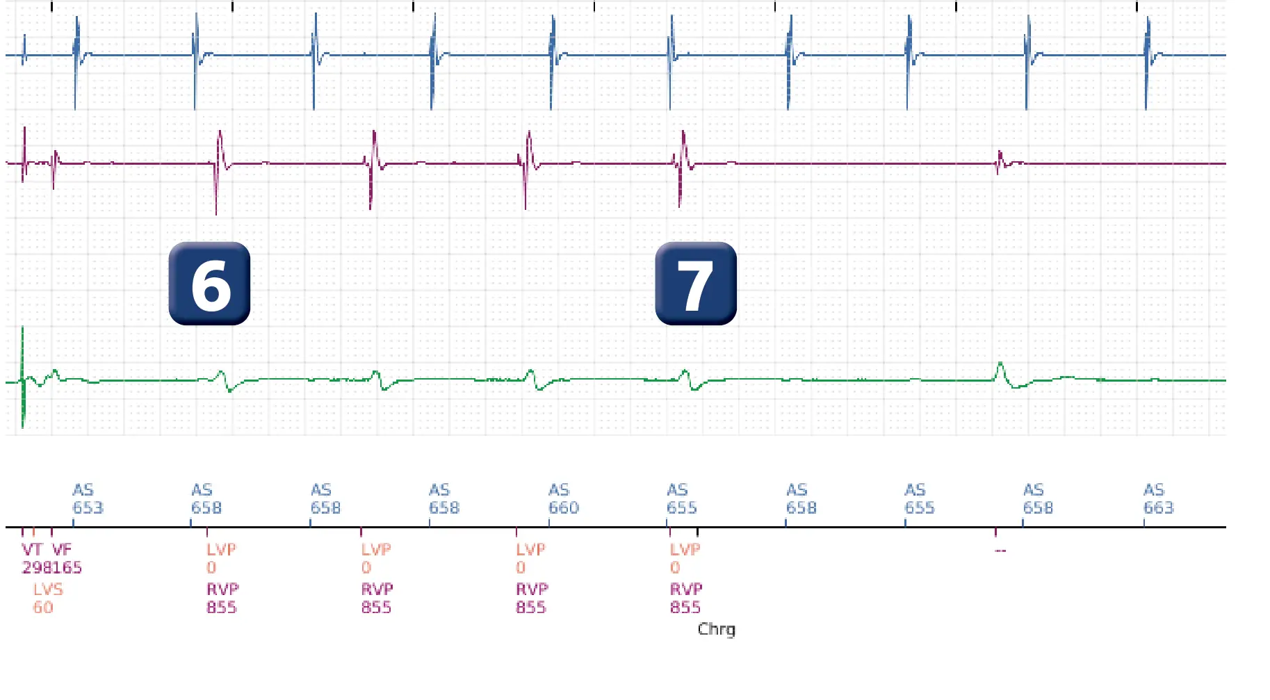 Électrogramme Boston Scientific DAI, segment 6 sur 6 — Thérapies inappropriées lors d’une procédure de TAVI