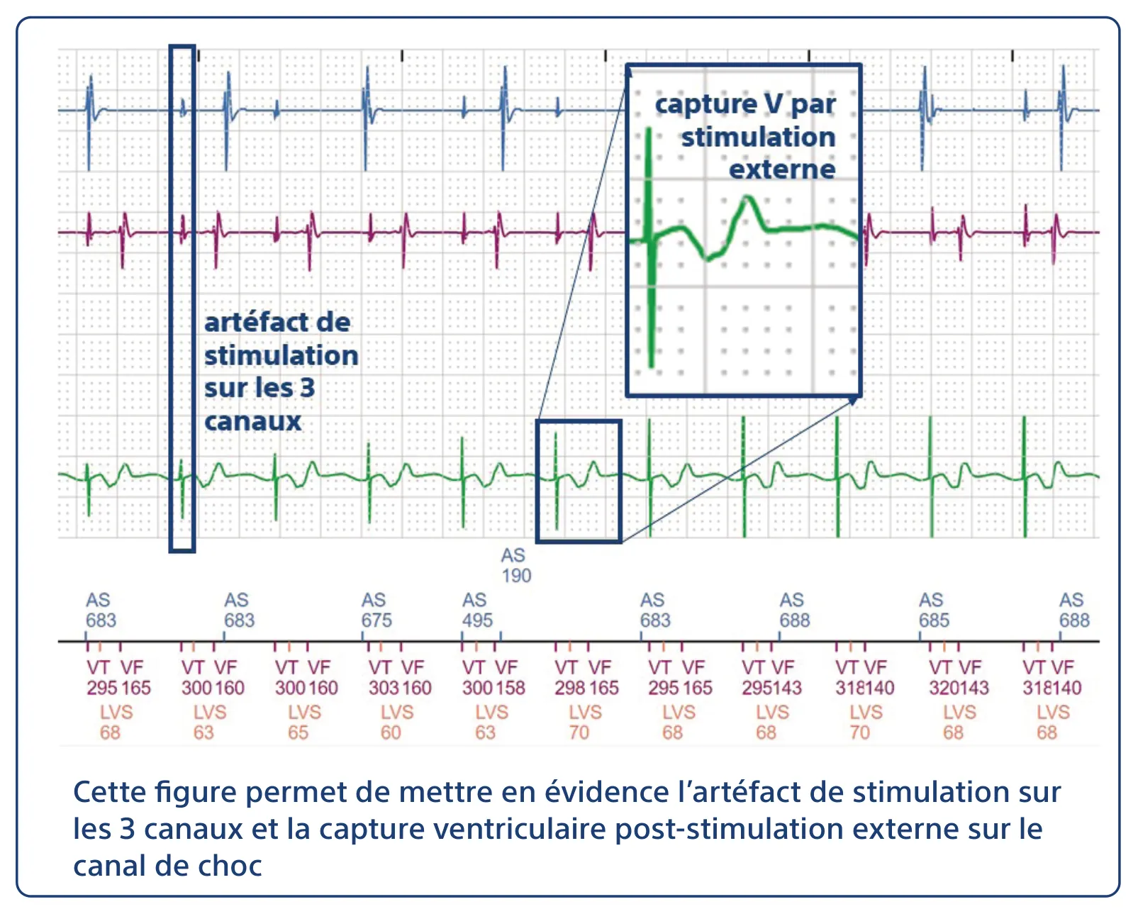 Cette figure permet de mettre en évidence l’artéfact de stimulation sur les 3 canaux et la capture ventriculaire post-stimulation externe sur le canal de choc