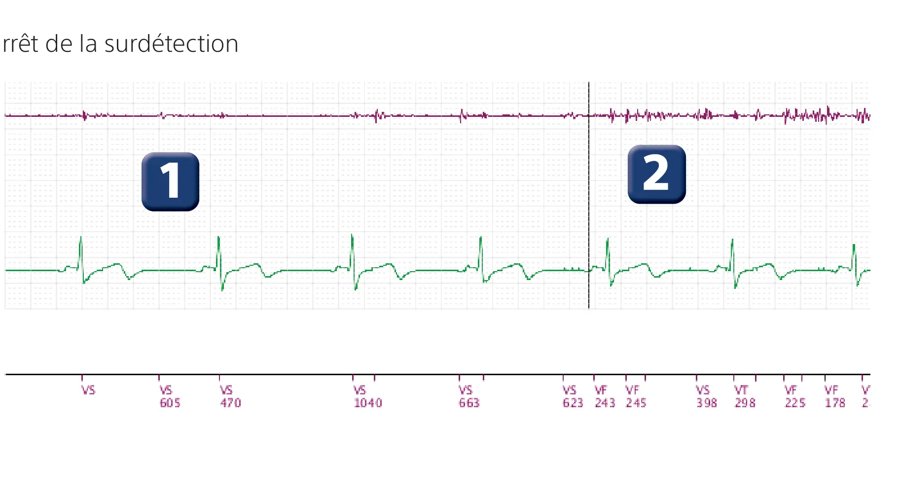 Électrogramme Boston Scientific DAI, segment 1 sur 3 — Rupture de sonde et charges multiples des condensateurs