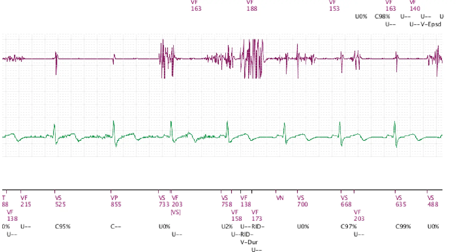 Électrogramme Boston Scientific DAI, segment 2 sur 3 — Rupture de sonde et charges multiples des condensateurs