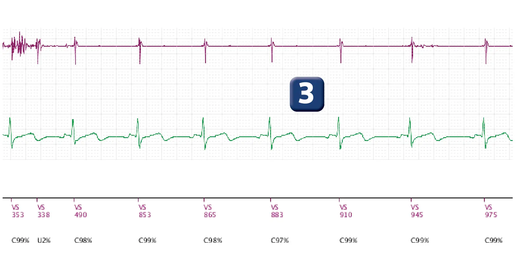 Électrogramme Boston Scientific DAI, segment 3 sur 3 — Rupture de sonde et charges multiples des condensateurs