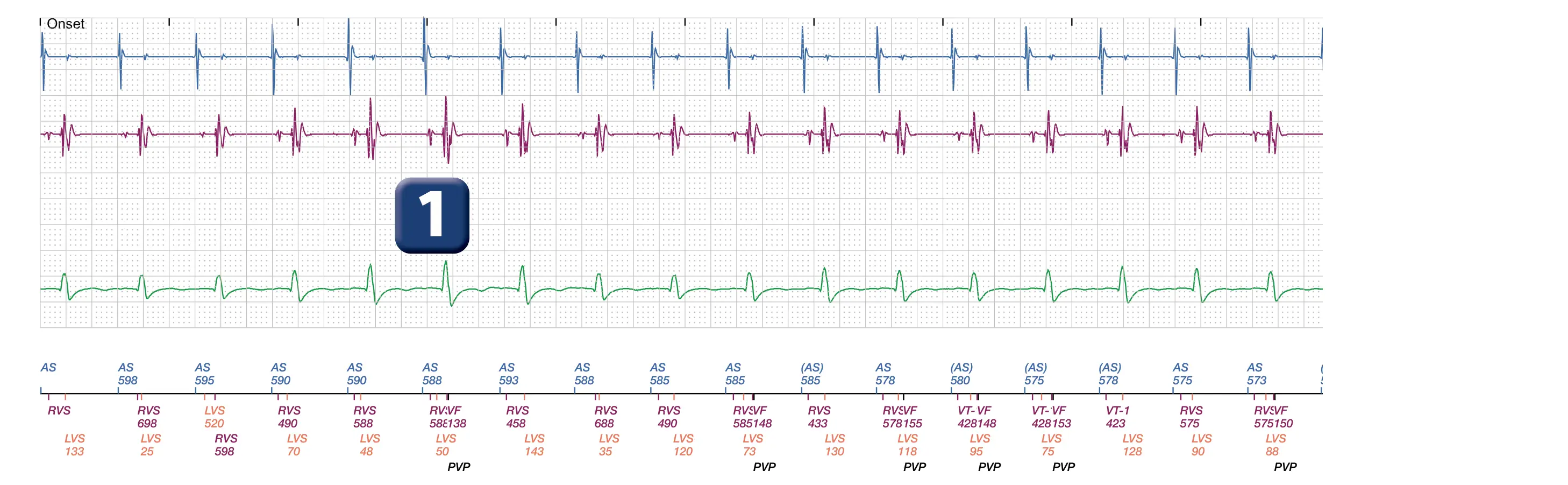 Électrogramme Boston Scientific DAI, segment 1 sur 2 — Surdétection de l’onde P