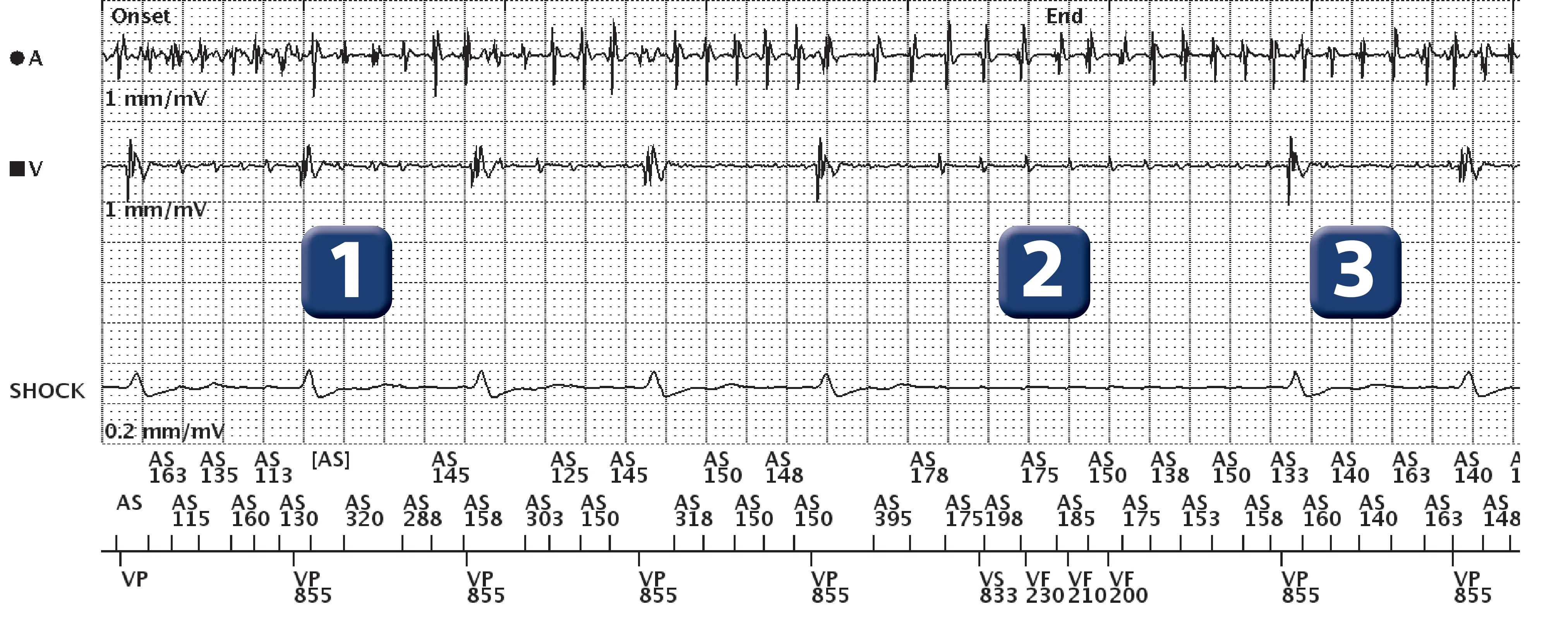 Électrogramme Boston Scientific DAI, segment 1 sur 1 — Surdétection ventriculaire de l’activité atriale pendant un épisode d’arythmie atriale