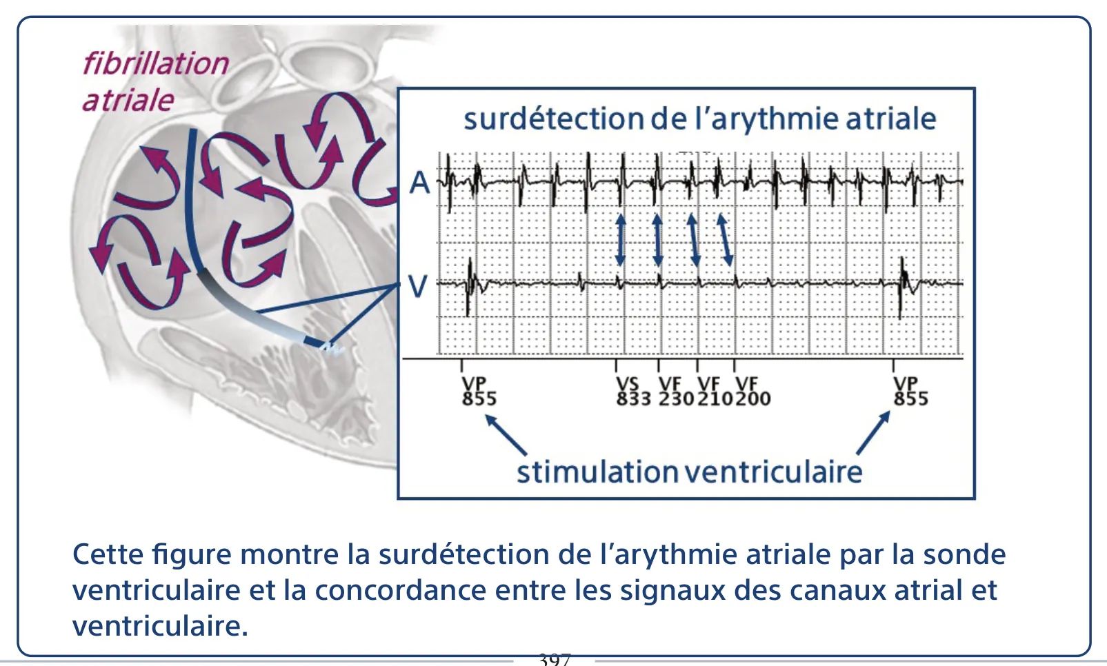 Cette figure montre la surdétection de l’arythmie atriale par la sonde ventriculaire et la concordance entre les signaux des canaux atrial et ventriculaire.