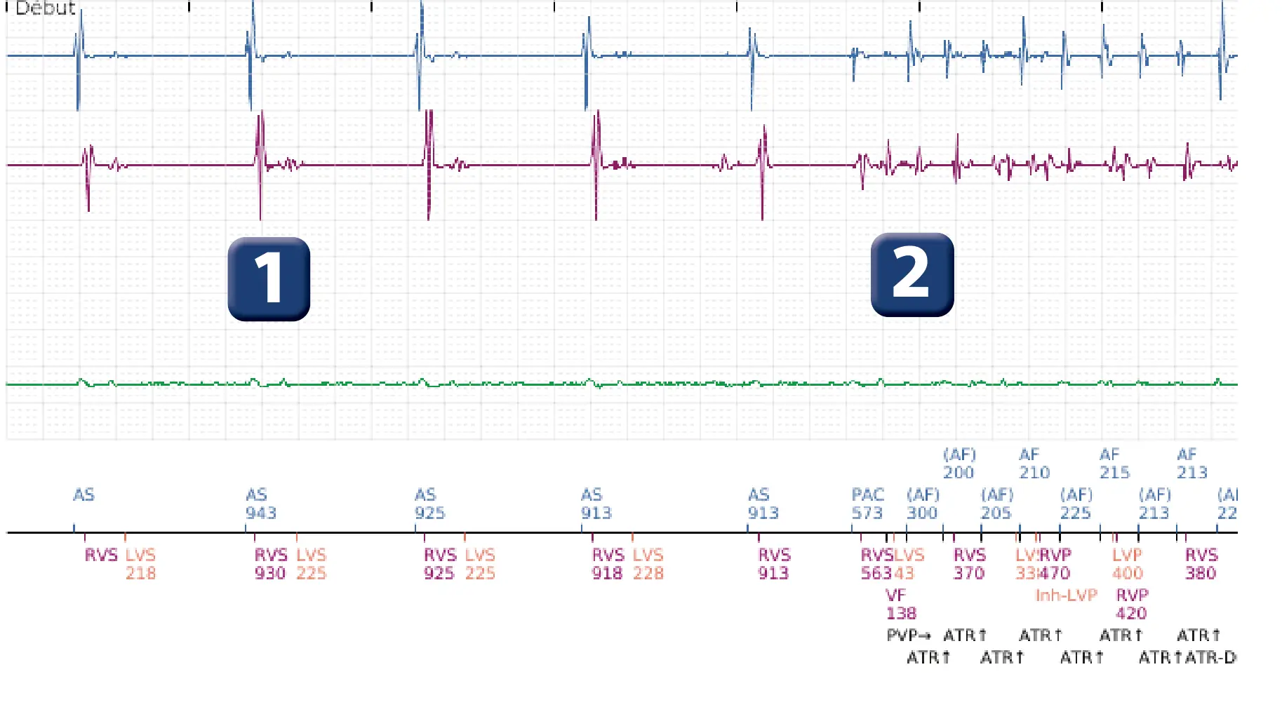 Électrogramme Boston Scientific DAI, segment 1 sur 8 — Déplacement précoce de la sonde ventriculaire droite dans l’oreillette