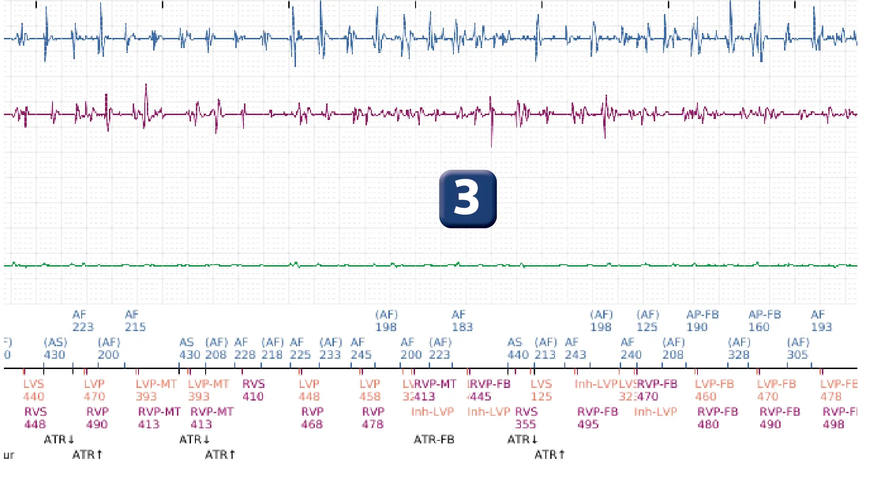 Électrogramme Boston Scientific DAI, segment 2 sur 8 — Déplacement précoce de la sonde ventriculaire droite dans l’oreillette