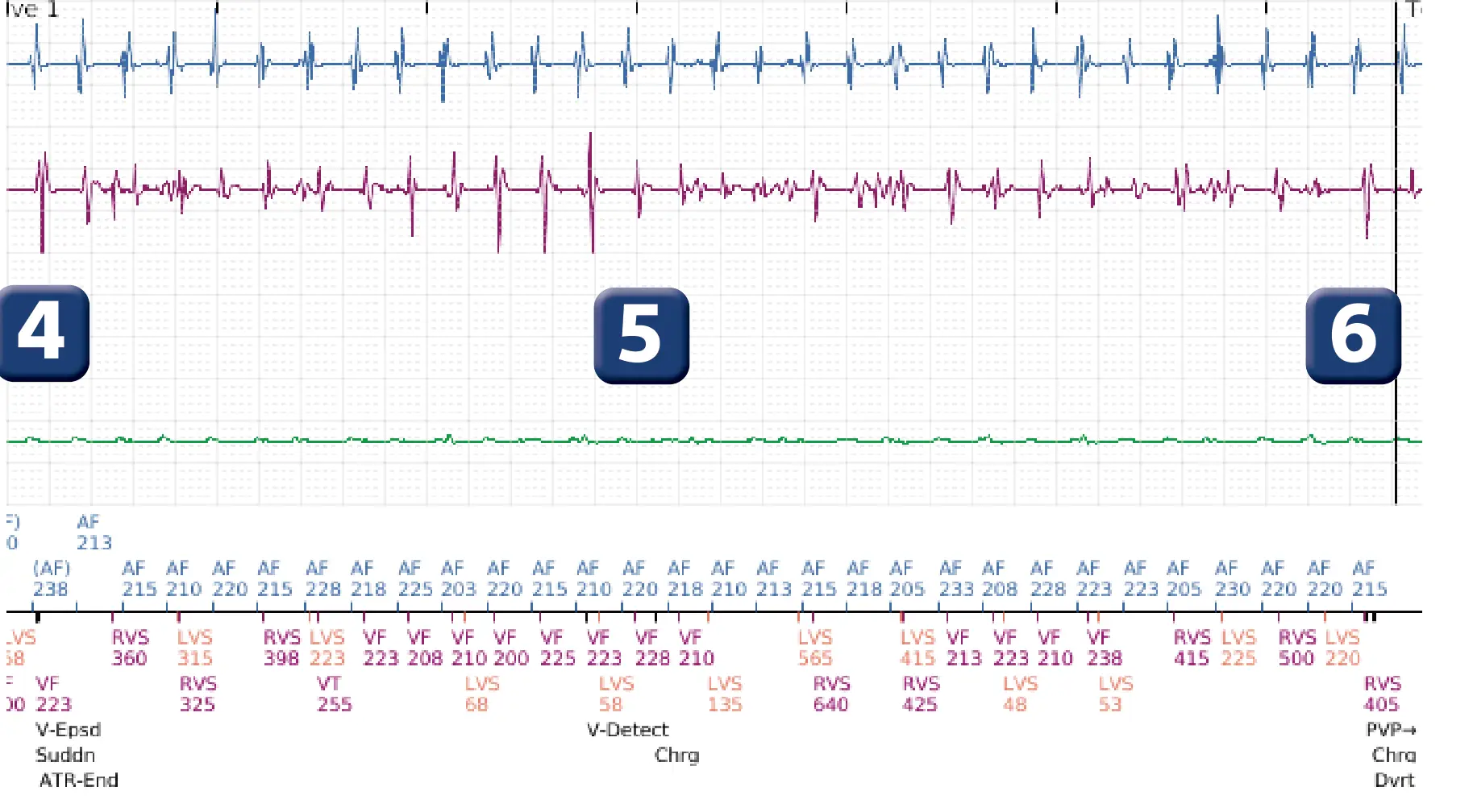 Électrogramme Boston Scientific DAI, segment 5 sur 8 — Déplacement précoce de la sonde ventriculaire droite dans l’oreillette
