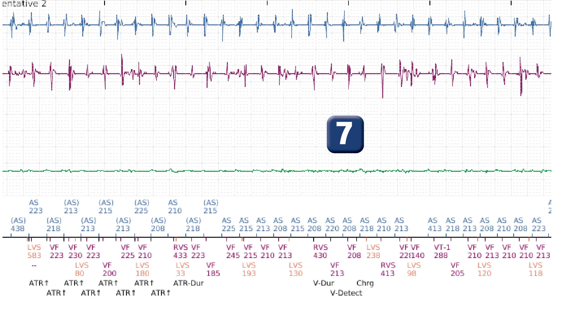 Électrogramme Boston Scientific DAI, segment 6 sur 8 — Déplacement précoce de la sonde ventriculaire droite dans l’oreillette