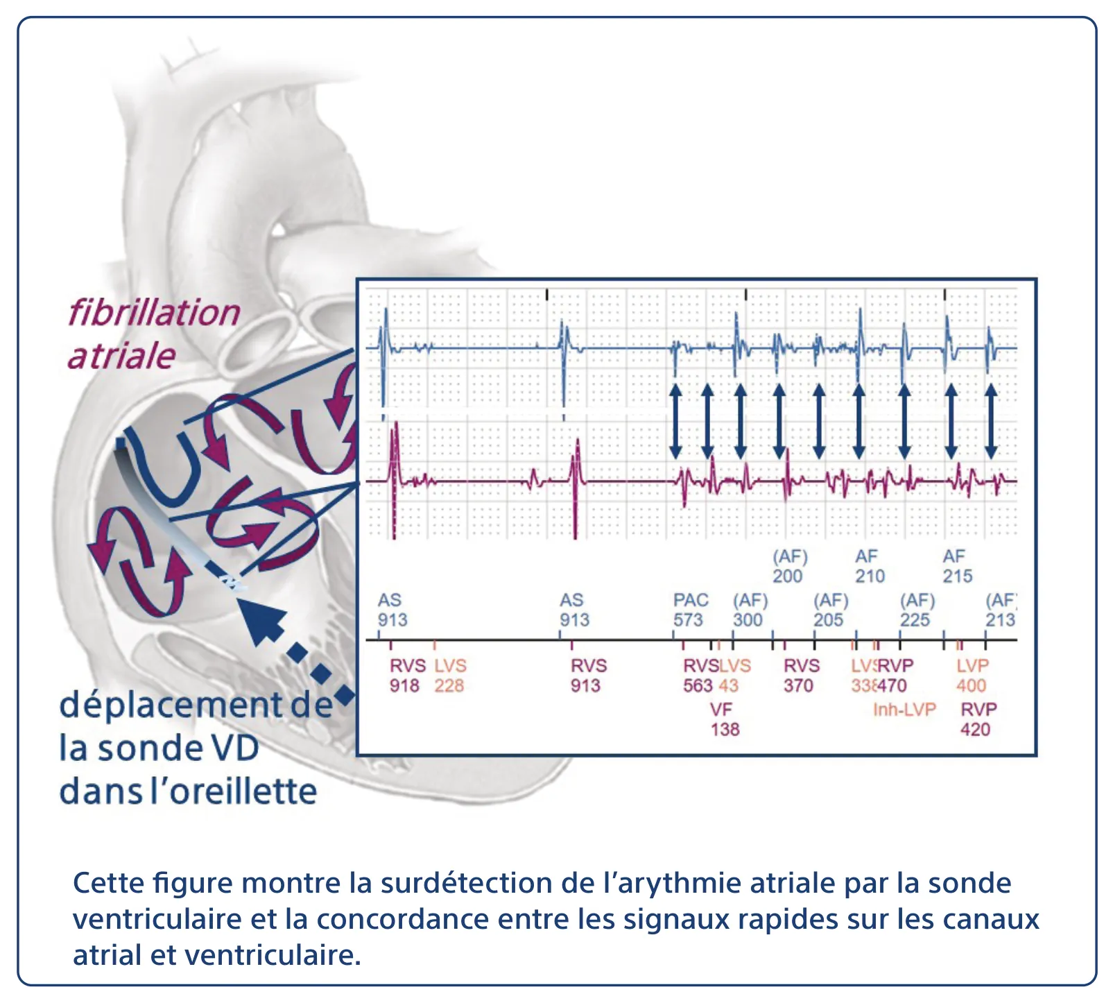 Cette figure montre la surdétection de l’arythmie atriale par la sonde ventriculaire et la concordance entre les signaux rapides sur les canaux atrial et ventriculaire.