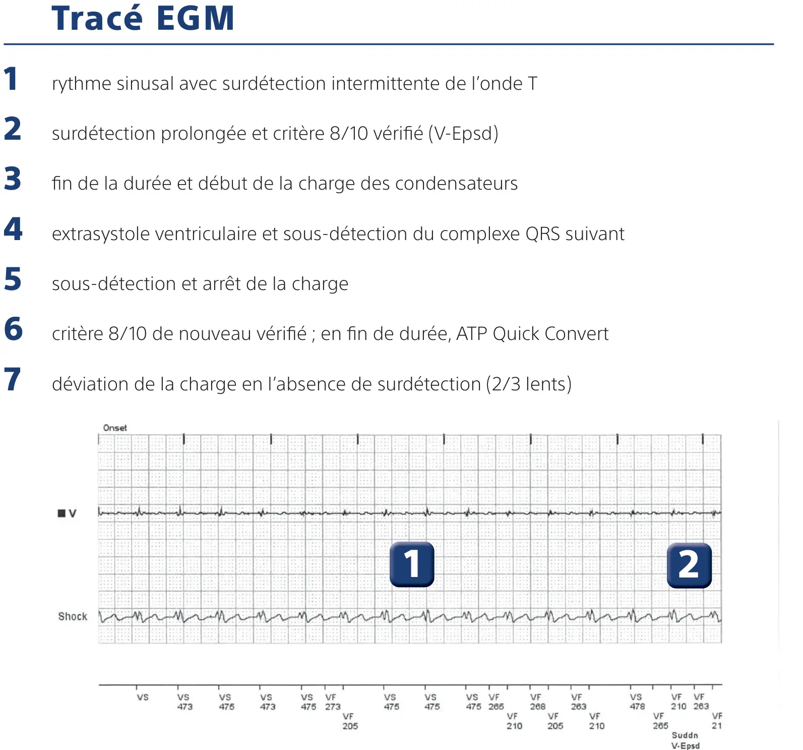 Électrogramme Boston Scientific DAI, segment 1 sur 5 — Surdétection de l’onde T